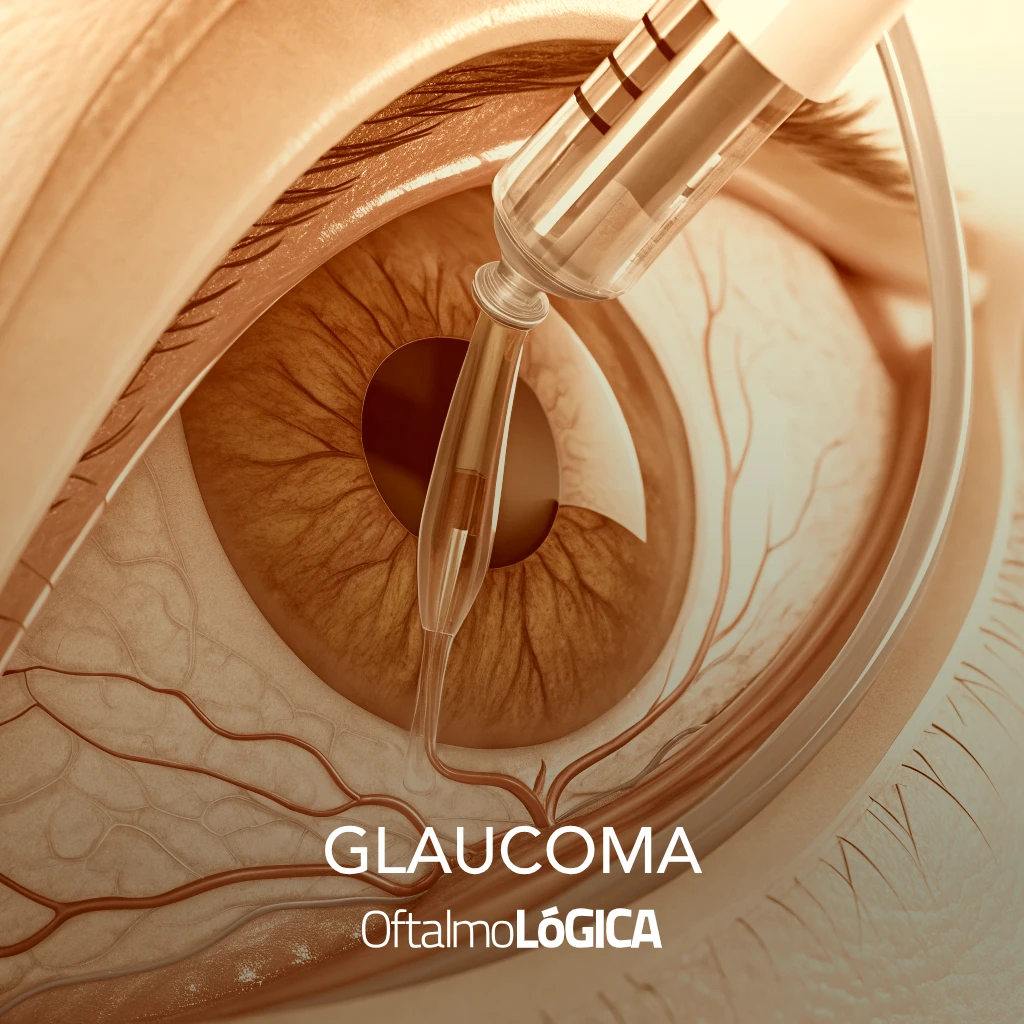 Representación médica del tratamiento del glaucoma, mostrando el drenaje ocular y las técnicas para reducir la presión intraocular @ Oftalmológica - Centro Oftalmológico Integral, Santo Domingo, República Dominicana