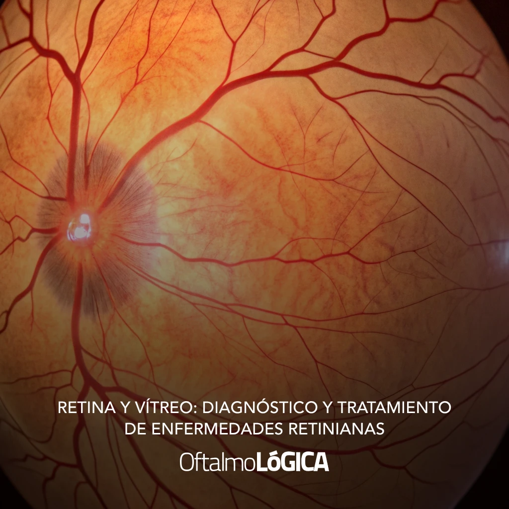 Imagen médica de la retina y el vítreo, mostrando los vasos sanguíneos y la estructura interna del ojo para diagnóstico preciso @ Oftalmológica | Centro Oftalmológico Integral, Santo Domingo, contamos con los mejores cirujanos y médicos oftalmólogos en República Dominicana